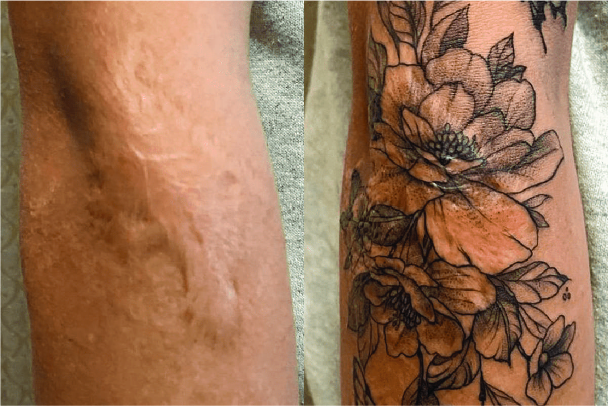 Scar or tattoo covering example